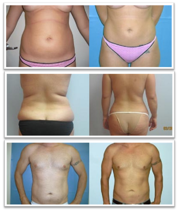 The Procedure For An Outpatient Liposuction Procedure Is